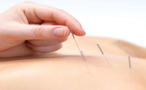 acupuncture treatment for back