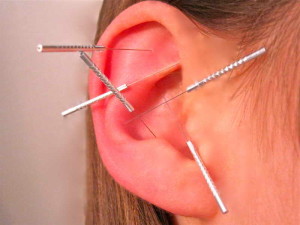 acupuncture treatment for ear