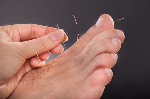 acupuncture treatment for feet