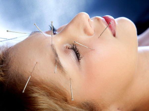 acupuncture treatment for head