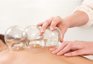 chinese cupping-in Palmers green